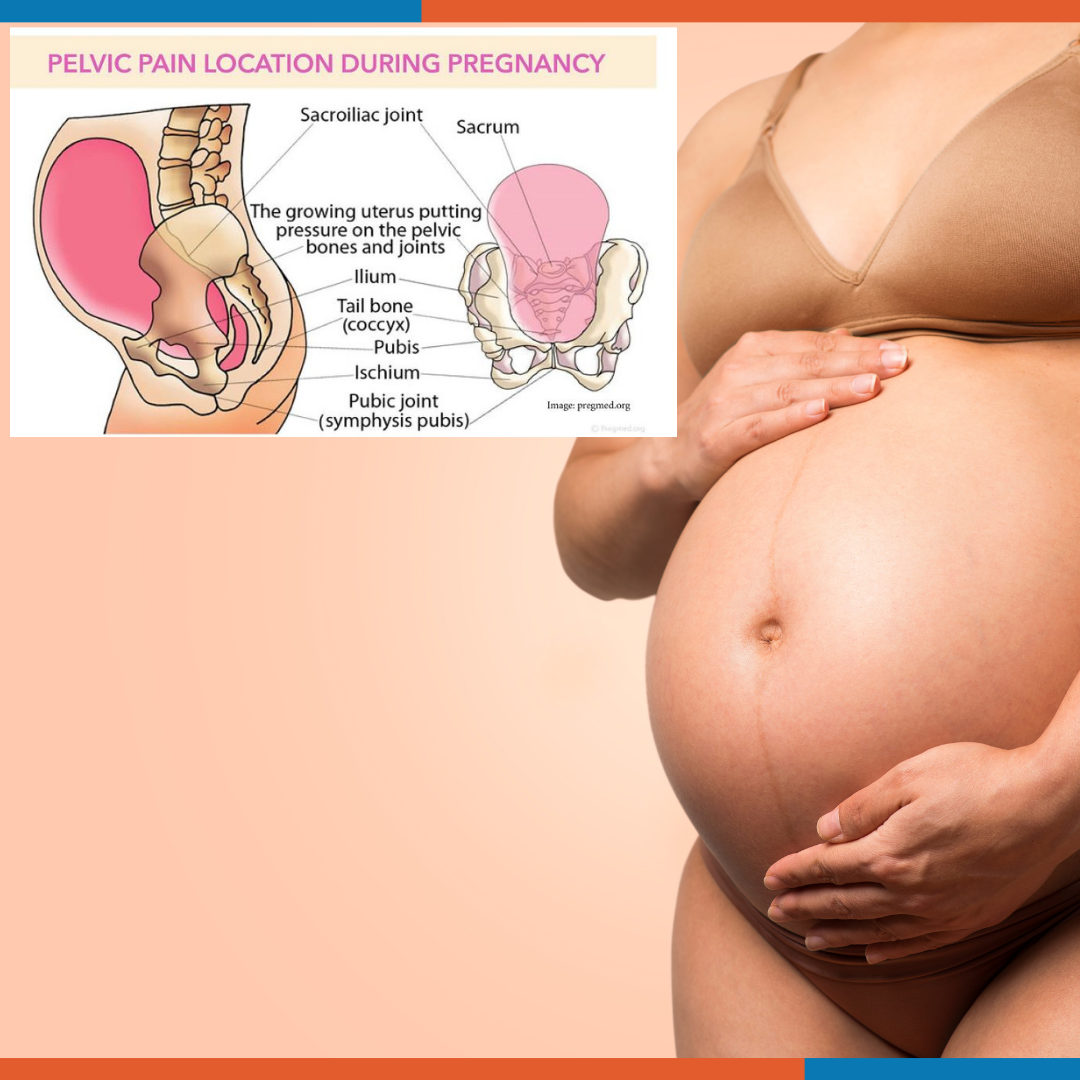 Symphysis Pubis Dysfunction and Pregnancy, symptoms and treatment